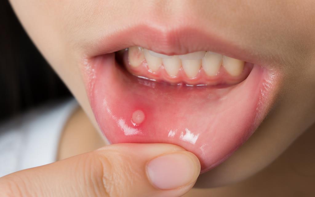 Close-up of a mouth ulcer on the inside of the lower lip